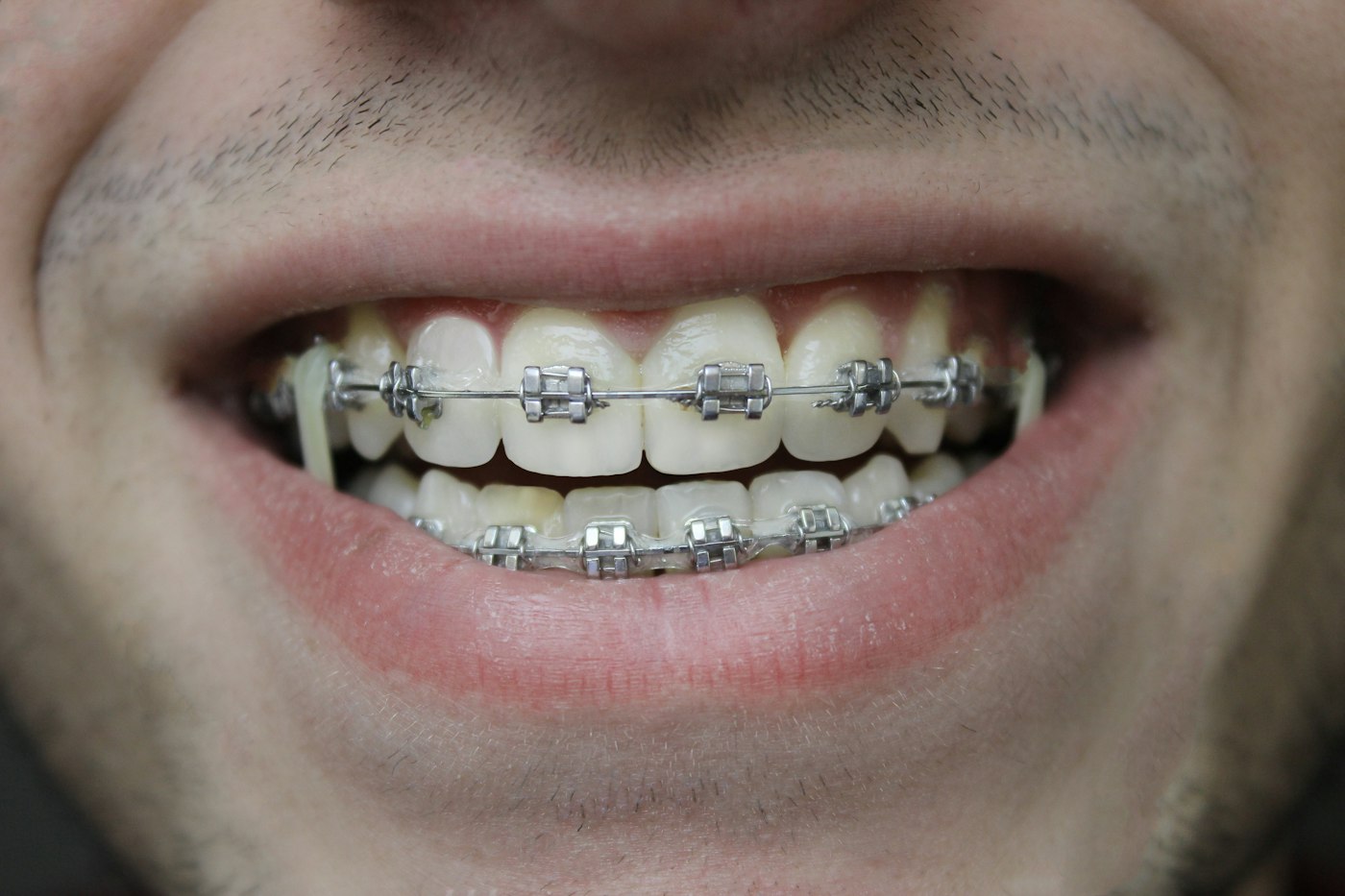 Close-up of a smile with metal braces